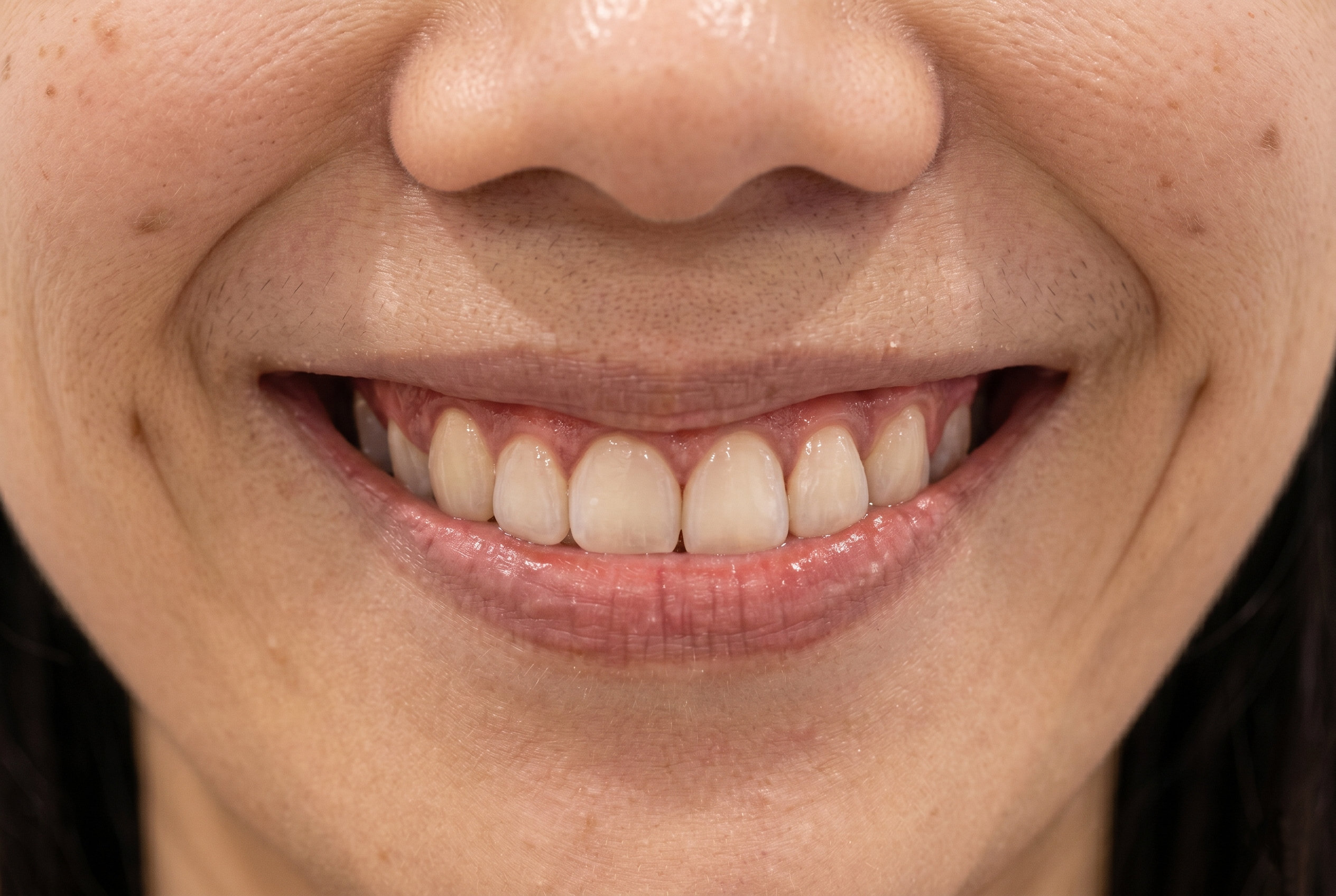 Gummy Smile Treatment - After
